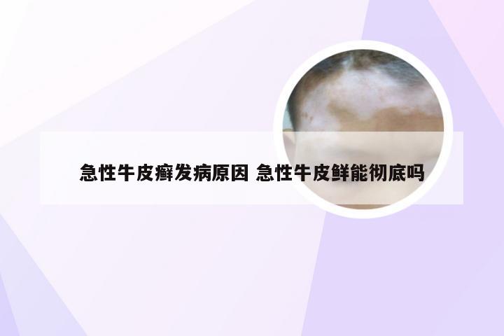 急性牛皮癣发病原因 急性牛皮鲜能彻底吗