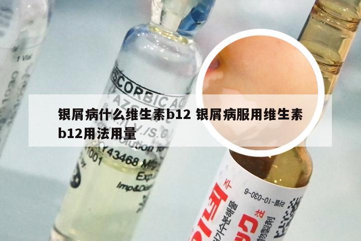 银屑病什么维生素b12 银屑病服用维生素b12用法用量