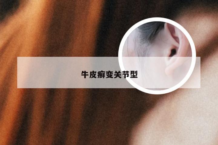 牛皮癣变关节型