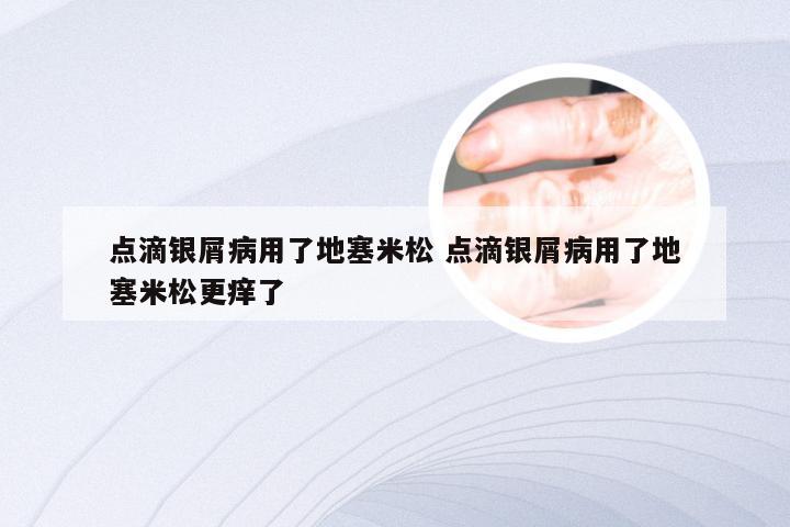 点滴银屑病用了地塞米松 点滴银屑病用了地塞米松更痒了