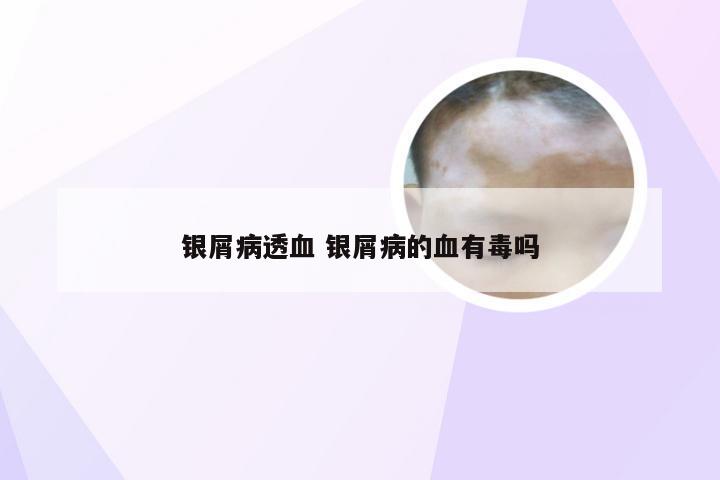 银屑病透血 银屑病的血有毒吗