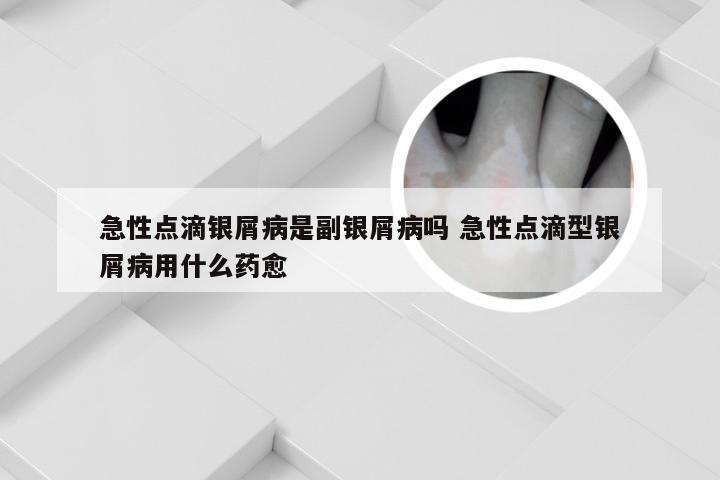 急性点滴银屑病是副银屑病吗 急性点滴型银屑病用什么药愈