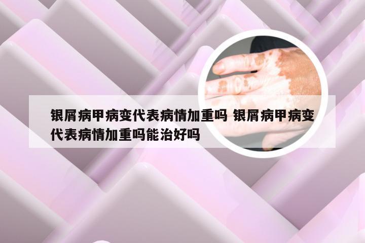 银屑病甲病变代表病情加重吗 银屑病甲病变代表病情加重吗能治好吗