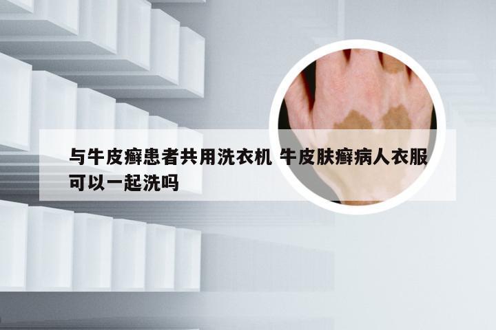 与牛皮癣患者共用洗衣机 牛皮肤癣病人衣服可以一起洗吗