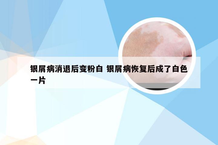 银屑病消退后变粉白 银屑病恢复后成了白色一片