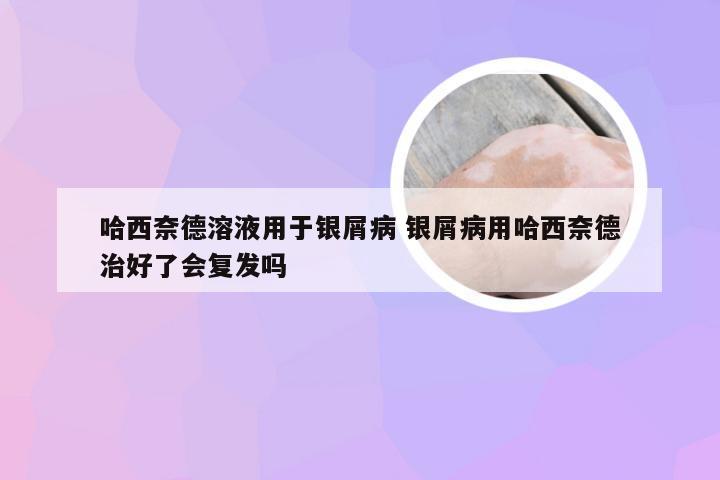 哈西奈德溶液用于银屑病 银屑病用哈西奈德治好了会复发吗