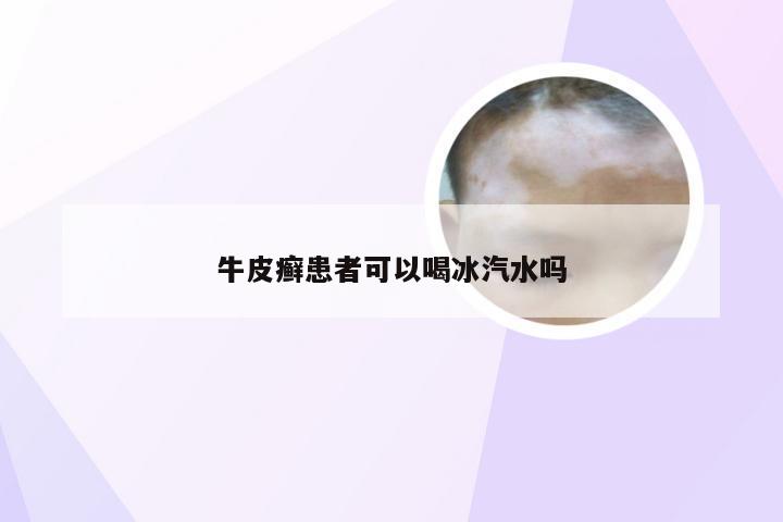 牛皮癣患者可以喝冰汽水吗