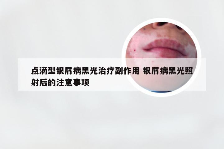 点滴型银屑病黑光治疗副作用 银屑病黑光照射后的注意事项