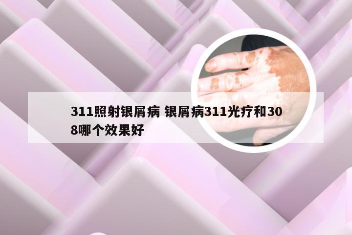 311照射银屑病 银屑病311光疗和308哪个效果好