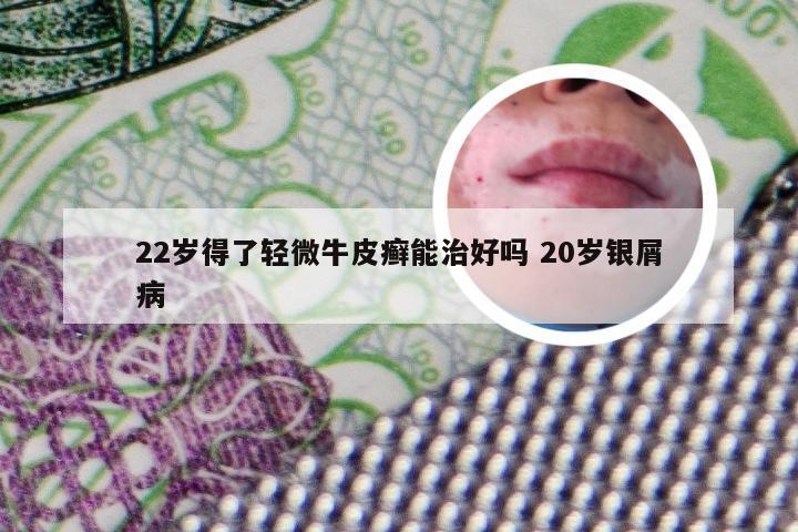 22岁得了轻微牛皮癣能治好吗 20岁银屑病