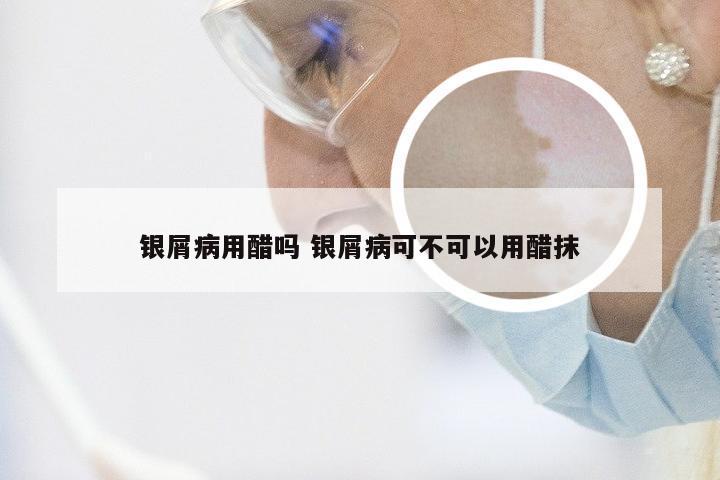 银屑病用醋吗 银屑病可不可以用醋抹