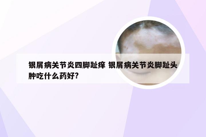 银屑病关节炎四脚趾痒 银屑病关节炎脚趾头肿吃什么药好?