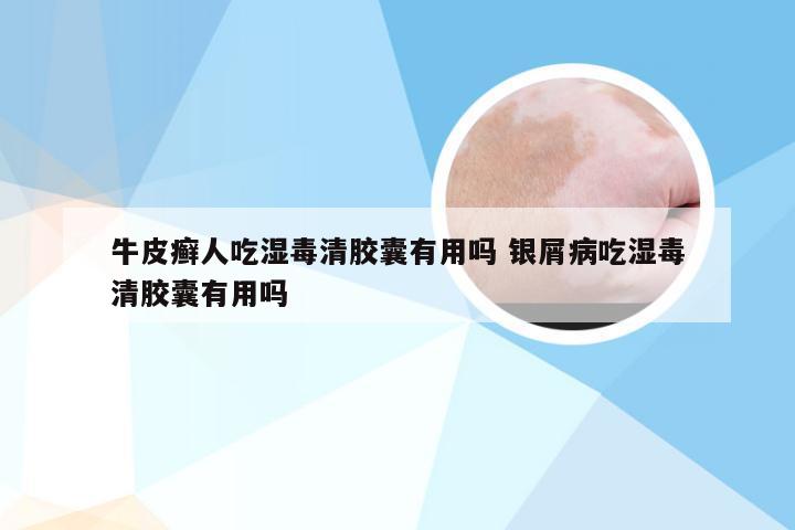 牛皮癣人吃湿毒清胶囊有用吗 银屑病吃湿毒清胶囊有用吗