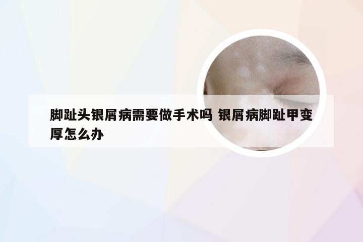 脚趾头银屑病需要做手术吗 银屑病脚趾甲变厚怎么办