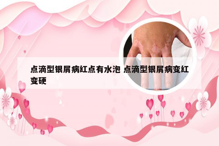 点滴型银屑病红点有水泡 点滴型银屑病变红变硬