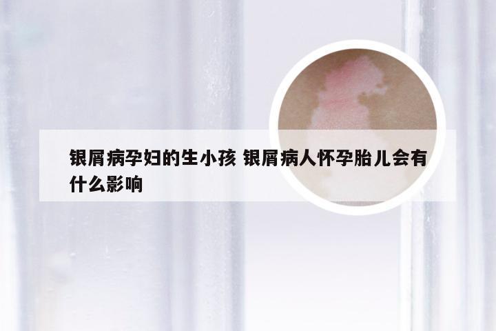 银屑病孕妇的生小孩 银屑病人怀孕胎儿会有什么影响