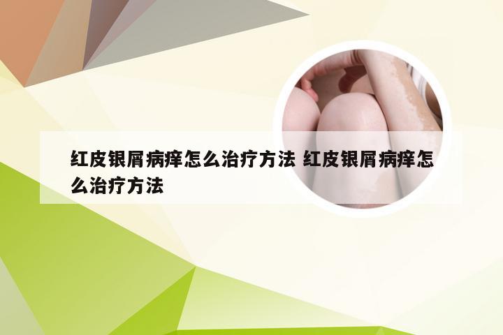 红皮银屑病痒怎么治疗方法 红皮银屑病痒怎么治疗方法