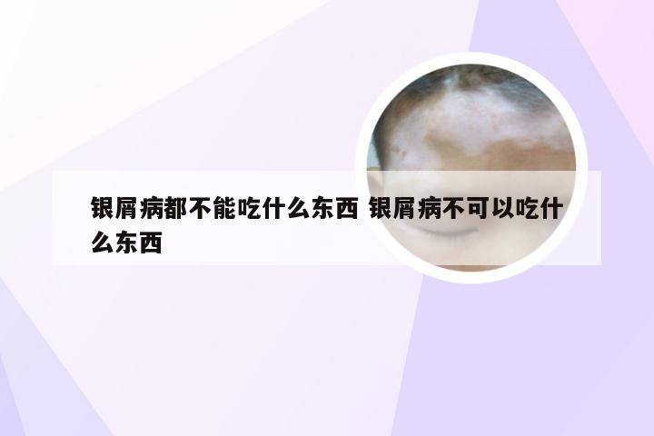 银屑病都不能吃什么东西 银屑病不可以吃什么东西