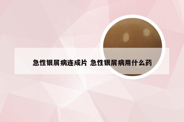 急性银屑病连成片 急性银屑病用什么药