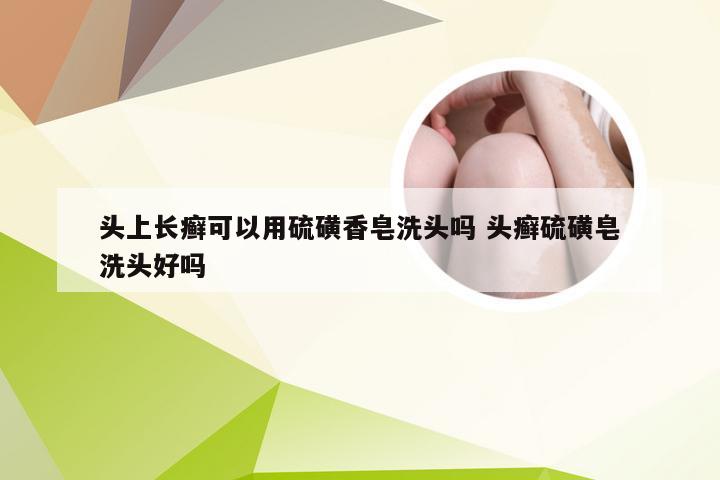 头上长癣可以用硫磺香皂洗头吗 头癣硫磺皂洗头好吗