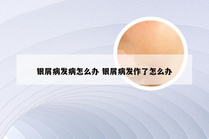 银屑病发病怎么办 银屑病发作了怎么办