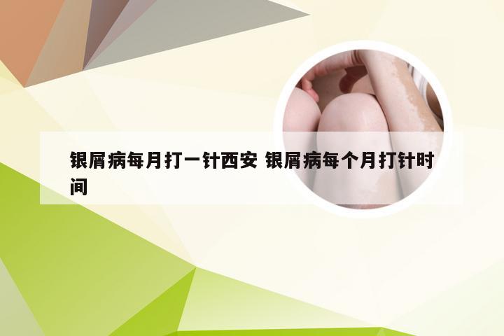 银屑病每月打一针西安 银屑病每个月打针时间