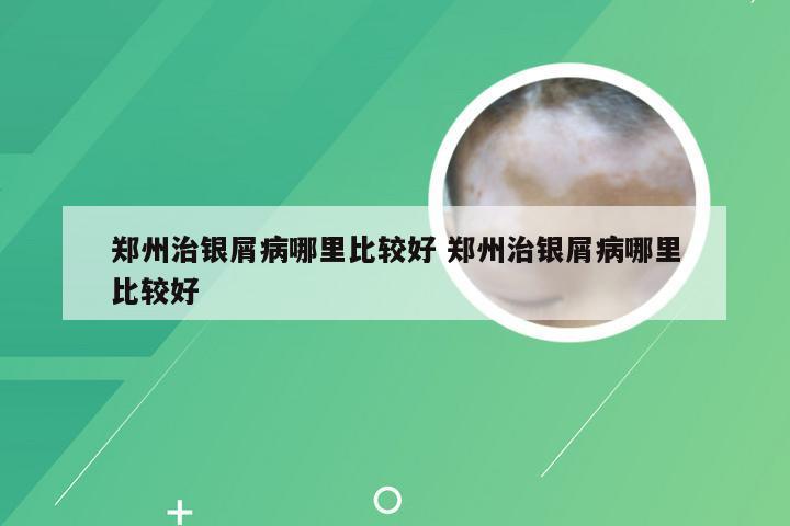 郑州治银屑病哪里比较好 郑州治银屑病哪里比较好