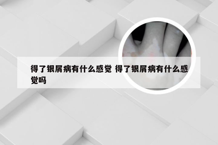 得了银屑病有什么感觉 得了银屑病有什么感觉吗