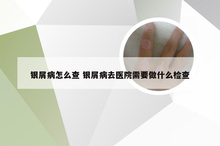 银屑病怎么查 银屑病去医院需要做什么检查