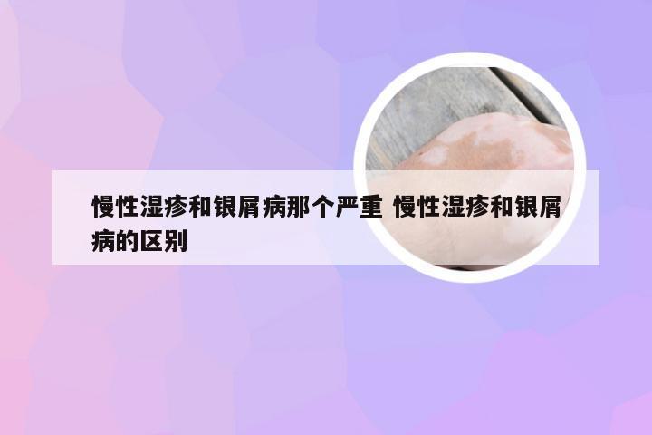 慢性湿疹和银屑病那个严重 慢性湿疹和银屑病的区别