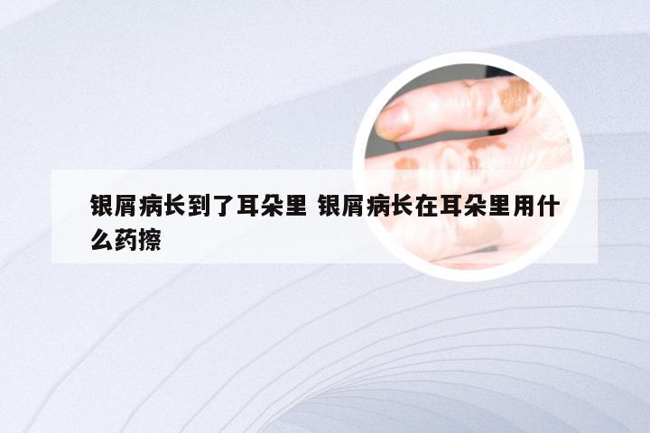 银屑病长到了耳朵里 银屑病长在耳朵里用什么药擦