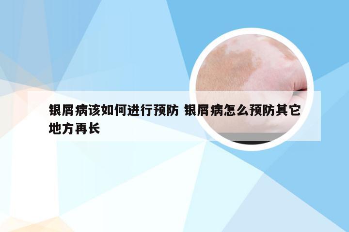 银屑病该如何进行预防 银屑病怎么预防其它地方再长