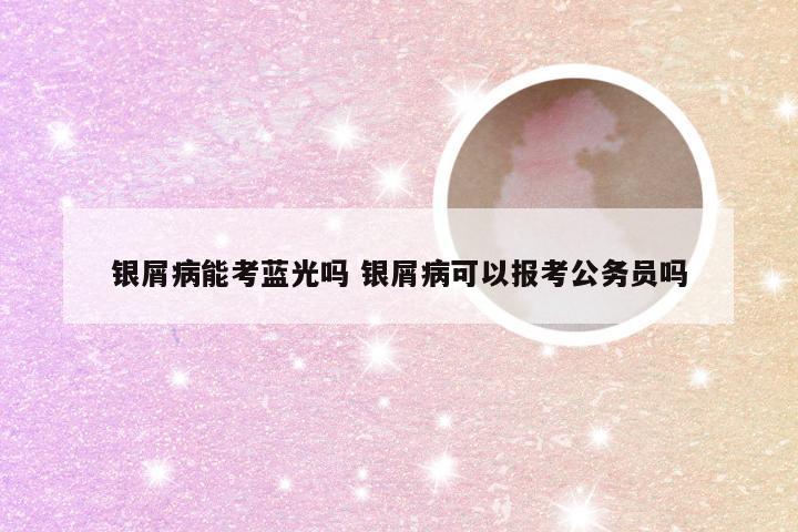 银屑病能考蓝光吗 银屑病可以报考公务员吗