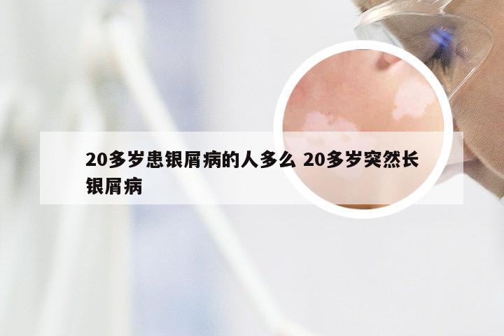 20多岁患银屑病的人多么 20多岁突然长银屑病