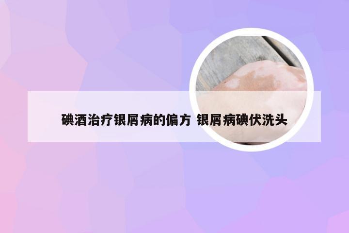 碘酒治疗银屑病的偏方 银屑病碘伏洗头