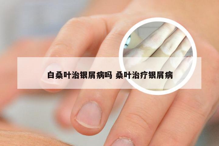 白桑叶治银屑病吗 桑叶治疗银屑病