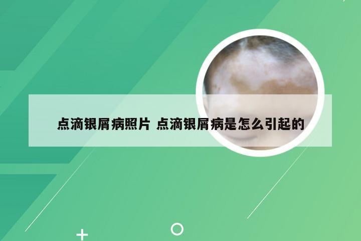 点滴银屑病照片 点滴银屑病是怎么引起的