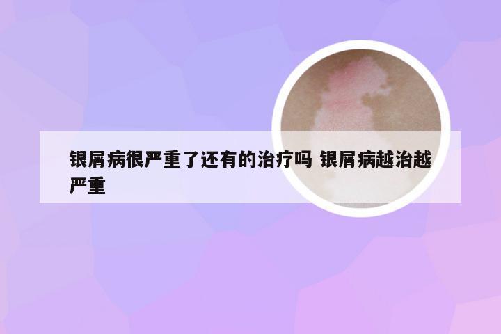 银屑病很严重了还有的治疗吗 银屑病越治越严重