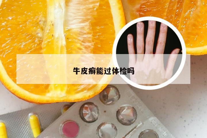 牛皮癣能过体检吗