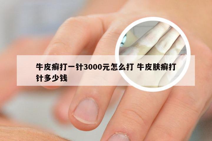 牛皮癣打一针3000元怎么打 牛皮肤癣打针多少钱