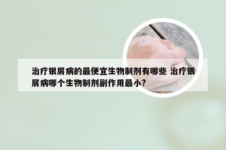 治疗银屑病的最便宜生物制剂有哪些 治疗银屑病哪个生物制剂副作用最小?