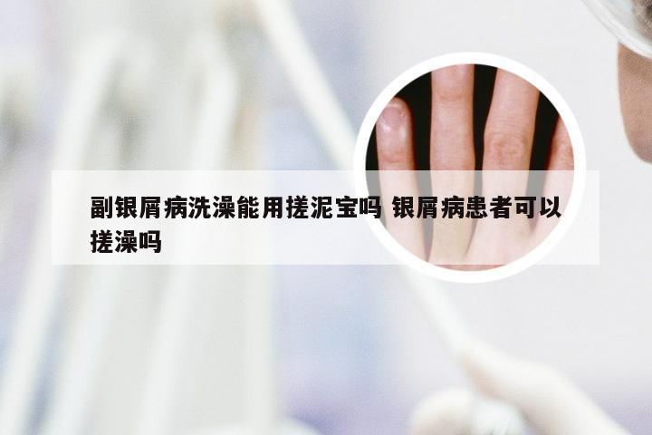 副银屑病洗澡能用搓泥宝吗 银屑病患者可以搓澡吗