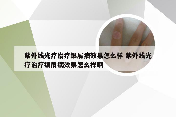 紫外线光疗治疗银屑病效果怎么样 紫外线光疗治疗银屑病效果怎么样啊