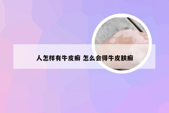 人怎样有牛皮癣 怎么会得牛皮肤癣