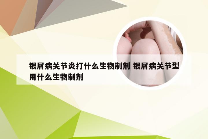 银屑病关节炎打什么生物制剂 银屑病关节型用什么生物制剂