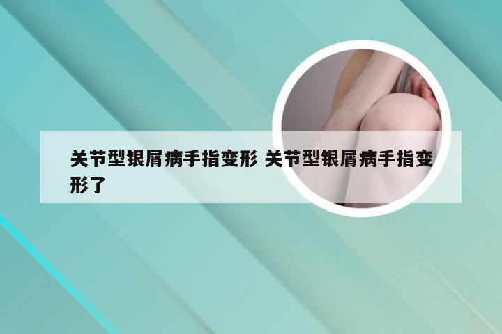 关节型银屑病手指变形 关节型银屑病手指变形了