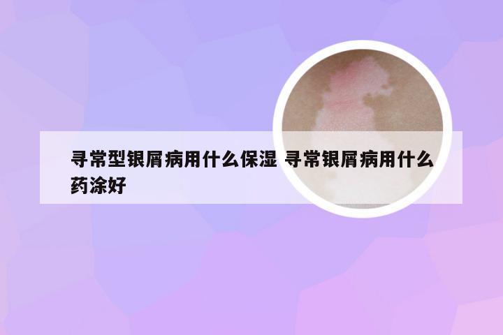 寻常型银屑病用什么保湿 寻常银屑病用什么药涂好