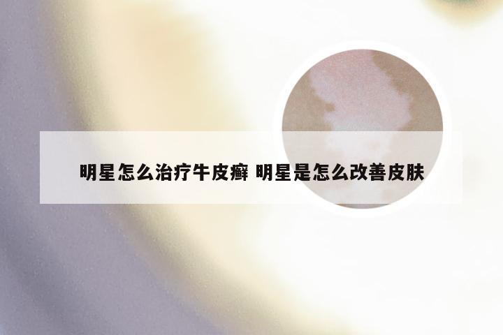 明星怎么治疗牛皮癣 明星是怎么改善皮肤