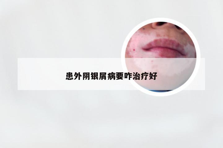 患外阴银屑病要咋治疗好