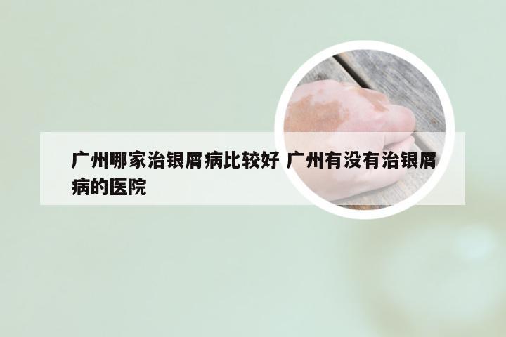 广州哪家治银屑病比较好 广州有没有治银屑病的医院